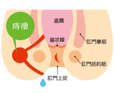 痔瘻（穴痔）