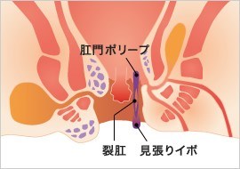 肛門ポリープ