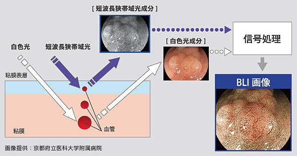 BLI（Blue　Laser　Imaging）